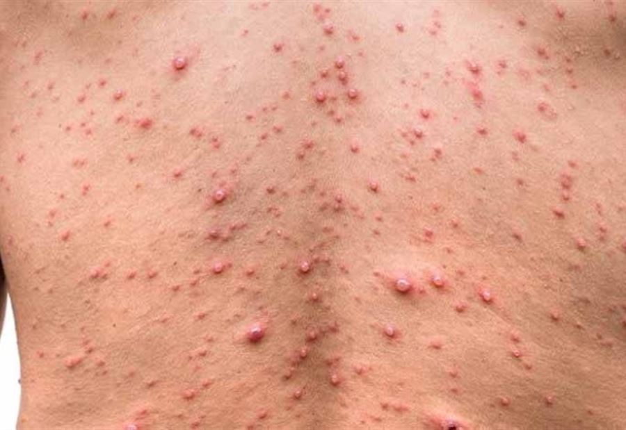 “For the first time”… a country reports a case of “smallpox”