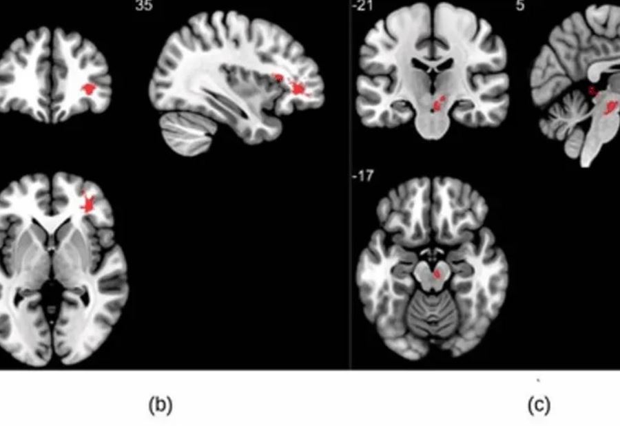 ‘Shocking’ Surprises About Brain Abnormalities After ‘Corona’!